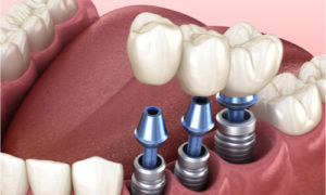 dental implant material