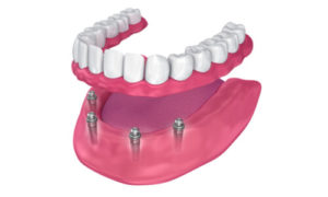 full mouth dental implants procedure